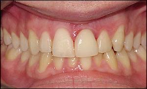 Port Hope Dental - Crowns