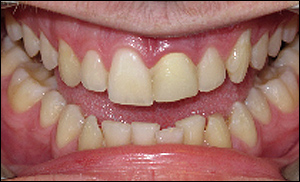 Port Hope Dental - Crowns