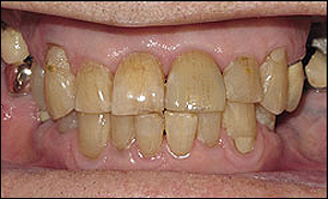 Port Hope Dental - Crowns