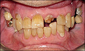 Port Hope Dental - Crowns