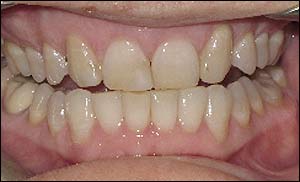 Port Hope Dental - Crowns