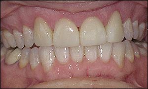 Port Hope Dental - Crowns