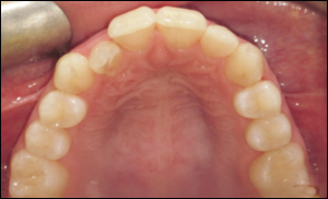 Port Hope Dental - Invisalign