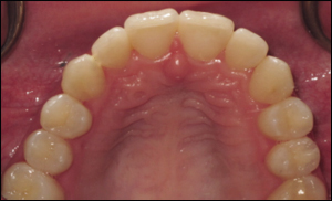 Port Hope Dental - Invisalign
