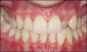 Port Hope Dental - Crowns