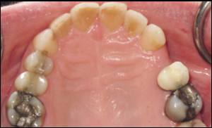 Port Hope Dental - Invisalign