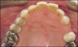 Port Hope Dental - Invisalign