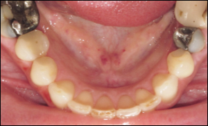 Port Hope Dental - Crowns