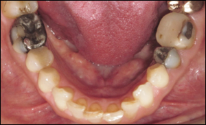 Port Hope Dental - Crowns