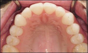 Port Hope Dental - Invisalign