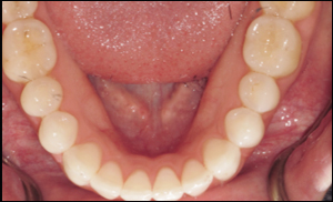 Port Hope Dental - Invisalign