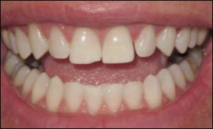 After Zoom Smile Whitening
