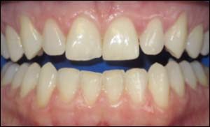 Before Zoom Smile Whitening