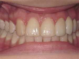 Port Hope Dental - Bridges