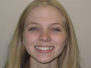 Port Hope Dental - Bridges