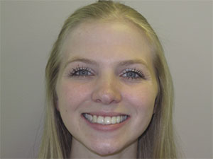 Port Hope Dental - Bridges